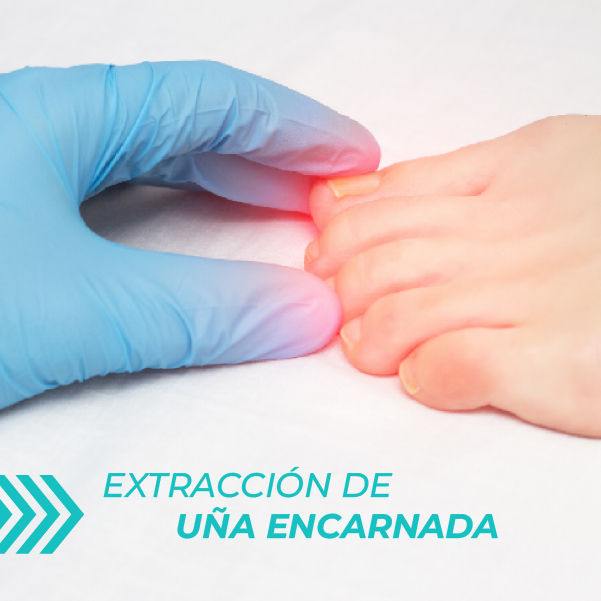 Uñas encarnadas